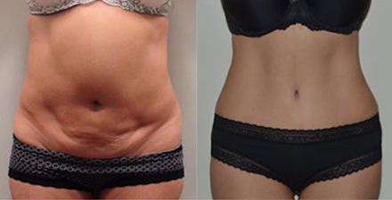 Are you ready for a Tummy Tuck? – Inland Cosmetic Surgery