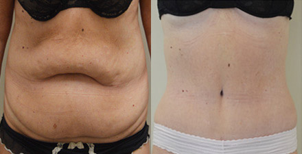 Eliminating A Bulging Belly With A Tummy Tuck - Dr Hamid Our